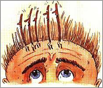 Что такое реактивное выпадение волос