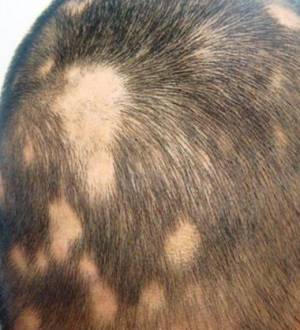 Сколько длится реакционное выпадение волос